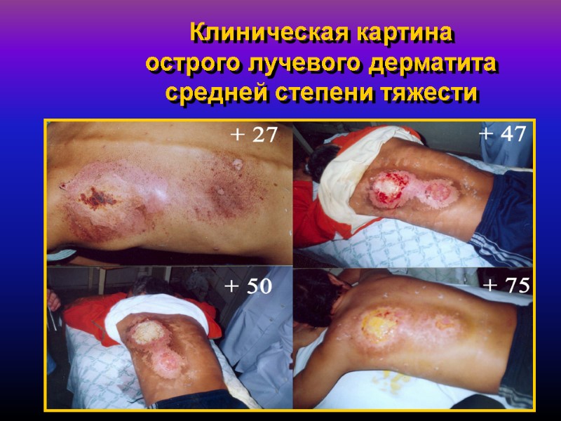 34 Клиническая картина  острого лучевого дерматита средней степени тяжести